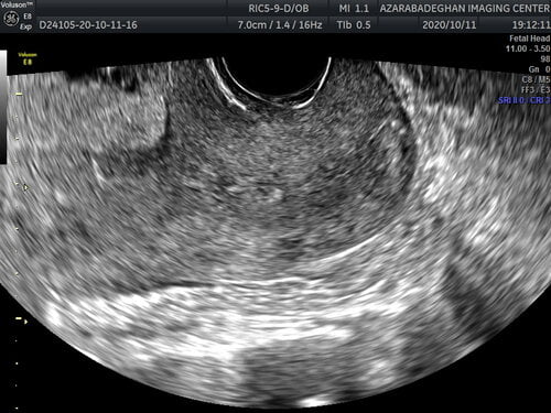 Cervical Scan: 16-40 weeks