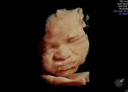 3D-4D-5D (HD Live) Scan: 18-34 weeks