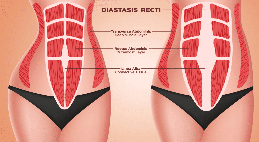 Diastasis Recti Ultrasound Scan